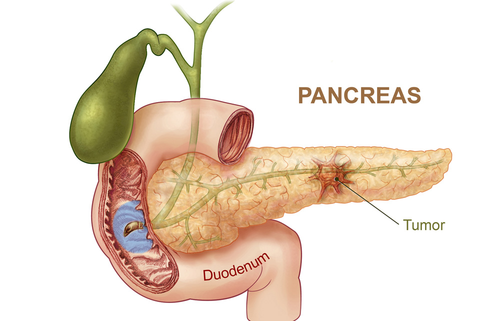 Pancreatic Cancer Charity